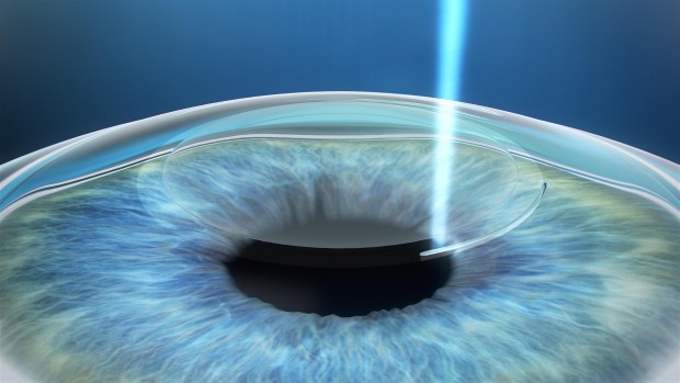 22 Saniyede Gözlük Kullanımına Son Veren ve İki Milyon Türk Lirasına Mal Olan En Gelimiş Göz Lazer Cihazı “ReLEx Smile Lazer” Uygulamaları için Hasta Kabulüne Başlandı