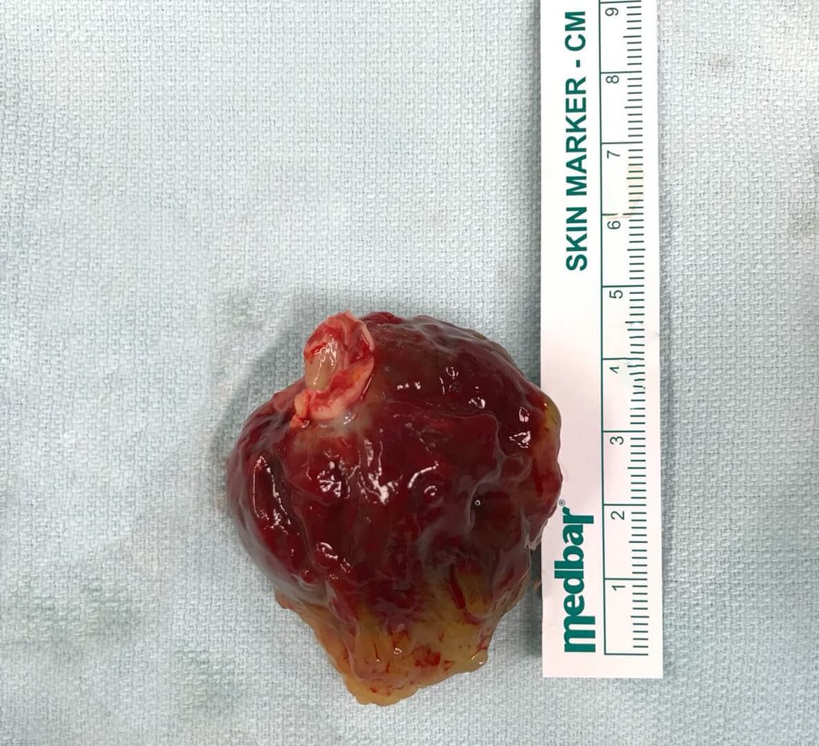 5 cm Tumor removed from Heart
